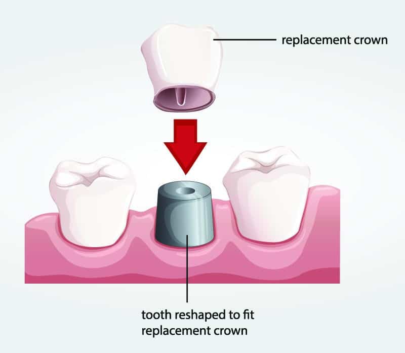 Dental Crowns Dental Knowledge Center Dentalsave Dental Plans