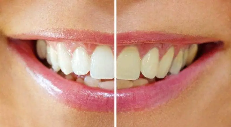safely whiten teeth before after
