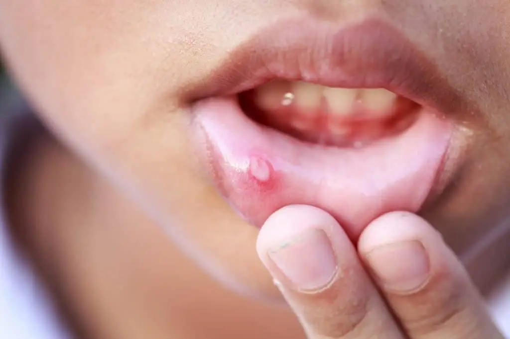 canker sores on child's lip