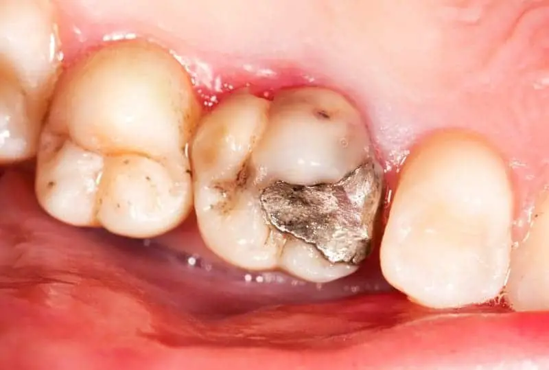 amalgam filling dental mercury