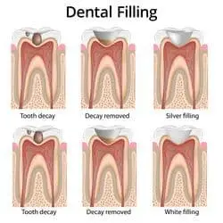 Dental and Tooth Cavity Filling | DentalSave Dental Plan